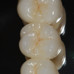 FPD Bruxir Solid Zirconia with Staining